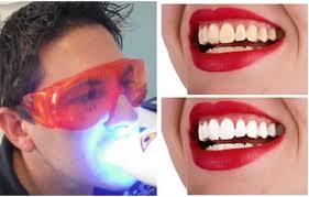 Blanqueamiento dental 50 €