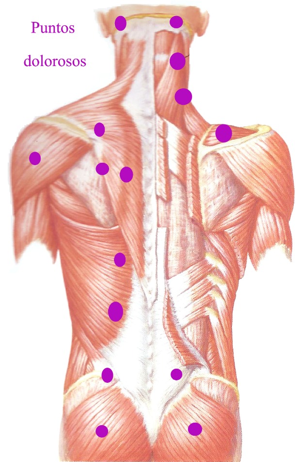 Dolores Musculares con Sistema Indiba