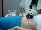 Ocasion equipo cavitacion profesional lipox - mejor precio | unprecio.es