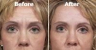 Cosmética natural antiarrugas - PARCHES FROWNIES para arrugas expresión - mejor precio | unprecio.es