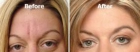Parches faciales antiarrugas Frownies - la alternativa al bótox 100 % natural - mejor precio | unprecio.es