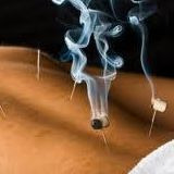 Acupuntura  y  moxibustion