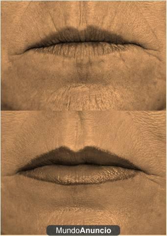 Parches CONTORNO DE LABIOS - código de barras, arruga nasogeniana
