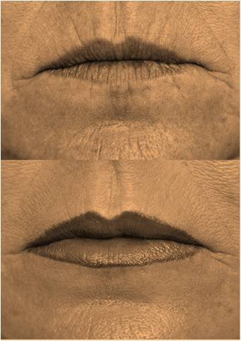 Reduce arrugas contorno de labios - Gentle Lifts